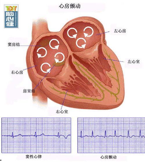 心肌肥厚日本,日本心肌肥厚研究进展与挑战
